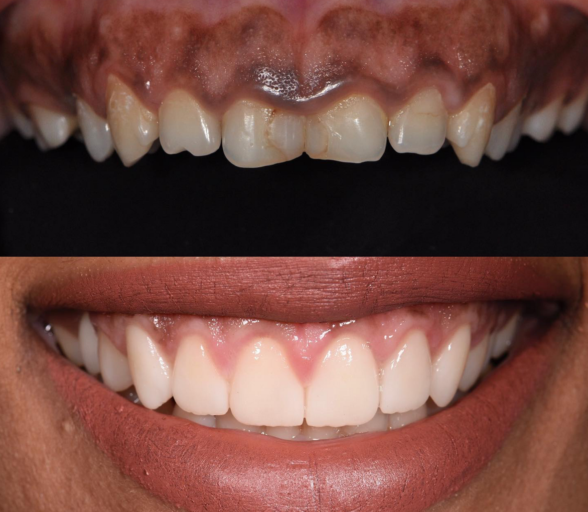 قبل وبعد تجميل اللثة وقص اللثة الزائدة — مركز مينا — جازان