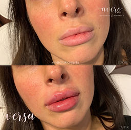 Pittsburgh Lip Filler Versa Revanesse