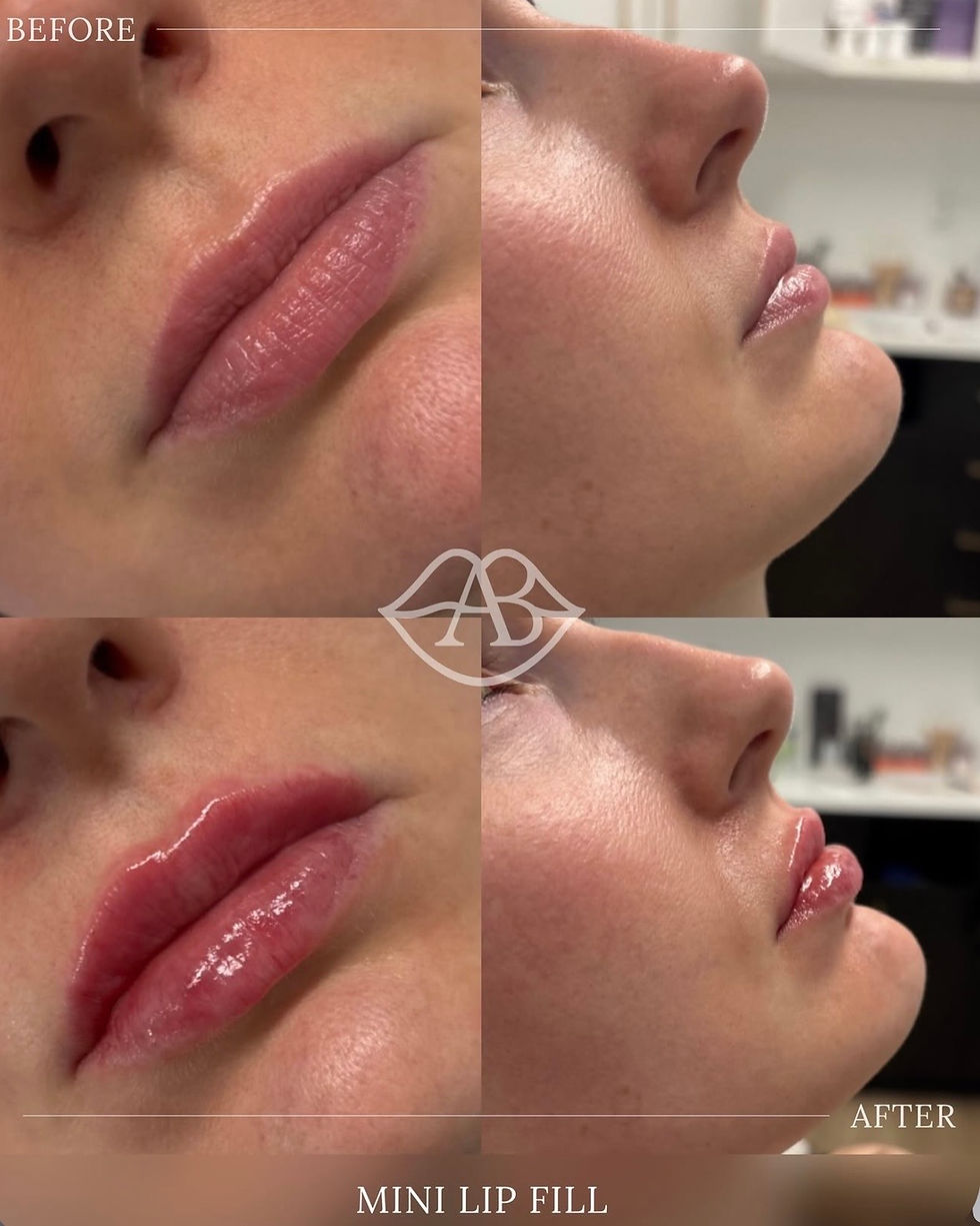 Mini lip fill before and after