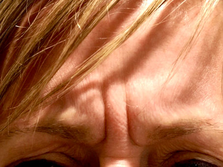 Botox Injections & Side Effects