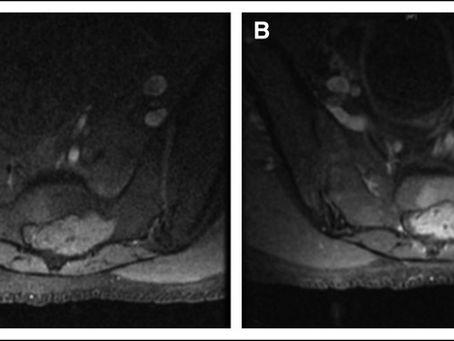 Why I Co‑Authored “Genomic Analysis Does Not Support Malignant Transformation of Osteoblastoma to Osteosarcoma”