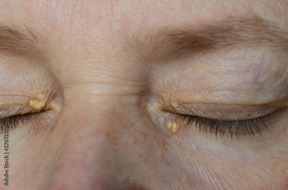 we offer specialised treatment for Xanthelasma, commonly referred to as cholesterol deposits.