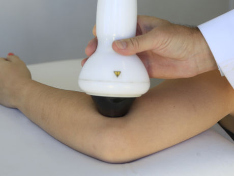 Epicondilite Lateral: Dor e Limitações no Cotovelo Tratadas com Ondas de Choque