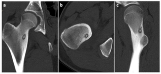 Tratamentul Minim Invaziv al Osteomului Osteoid prin Ablația cu Radiofrecvență