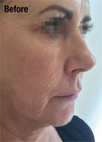 profhilo-before-3.jpg