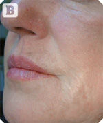 profhilo-after-5.jpg