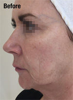 profhilo-before-2.jpg
