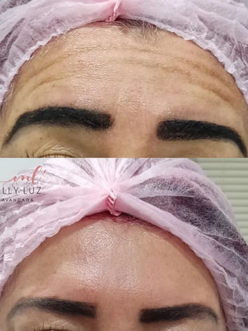preenchimento antes e depois