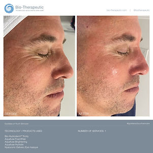 BT- BEFORE AND After