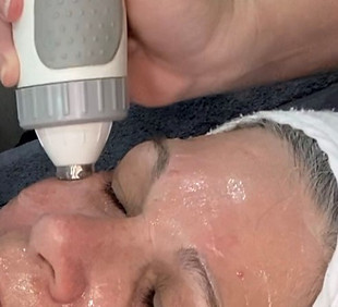 RF skin tightening