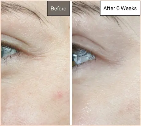 red light therapy before and after
