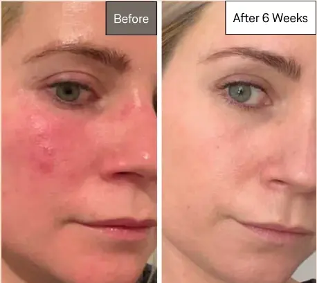Blue light therapy before and after
