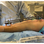Ilizarov Surgery -Restoring Strength and Mobility - Our Journey with Dr. Mahantesh Araganji