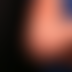 Sangue intero ozonizzato con procaina: caso clinico di lussazione del nervo ulnare