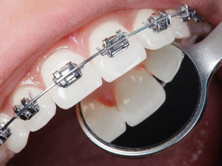 ORTODONZIA PER ADULTI