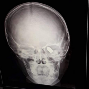 Bala perdida hiere en el ojo a niño mientras dormía en Chimalhuacán