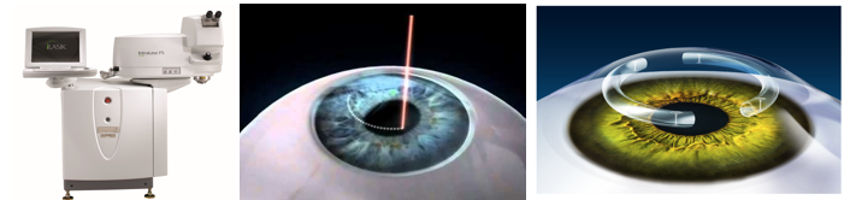 Anel Corneano com Laser.png