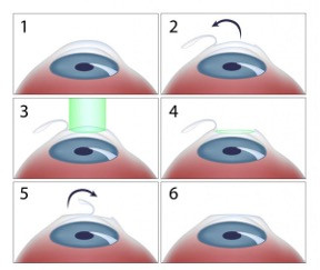 LASIK Refrativa a Laser