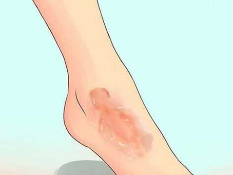 Cách chăm sóc vết bỏng bô xe máy đơn giản mà không để lại sẹo