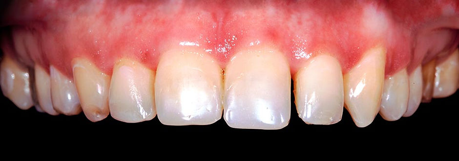 antes-aplicacao-faceta-de resina.jpg