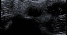 上腕二頭筋長頭腱断裂