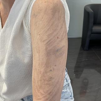 tattooentfernung zuich