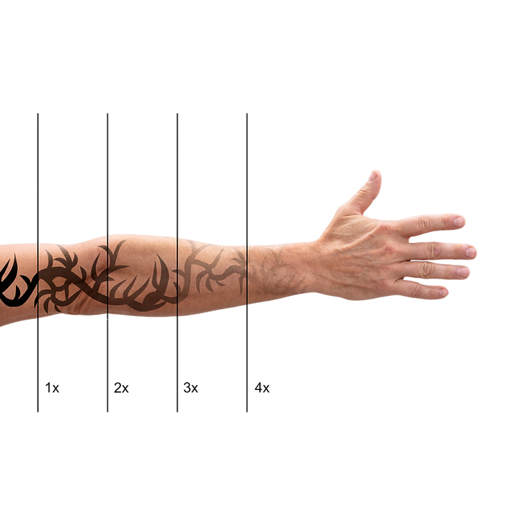 Tattooentfernung