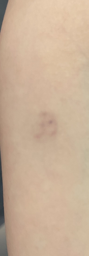 Tattoo-Entfernung in Zürich