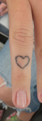 Tattooentfernung