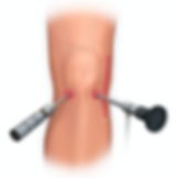 West London knee surgery, arthroscopy portal placement Mr Imbuldeniya