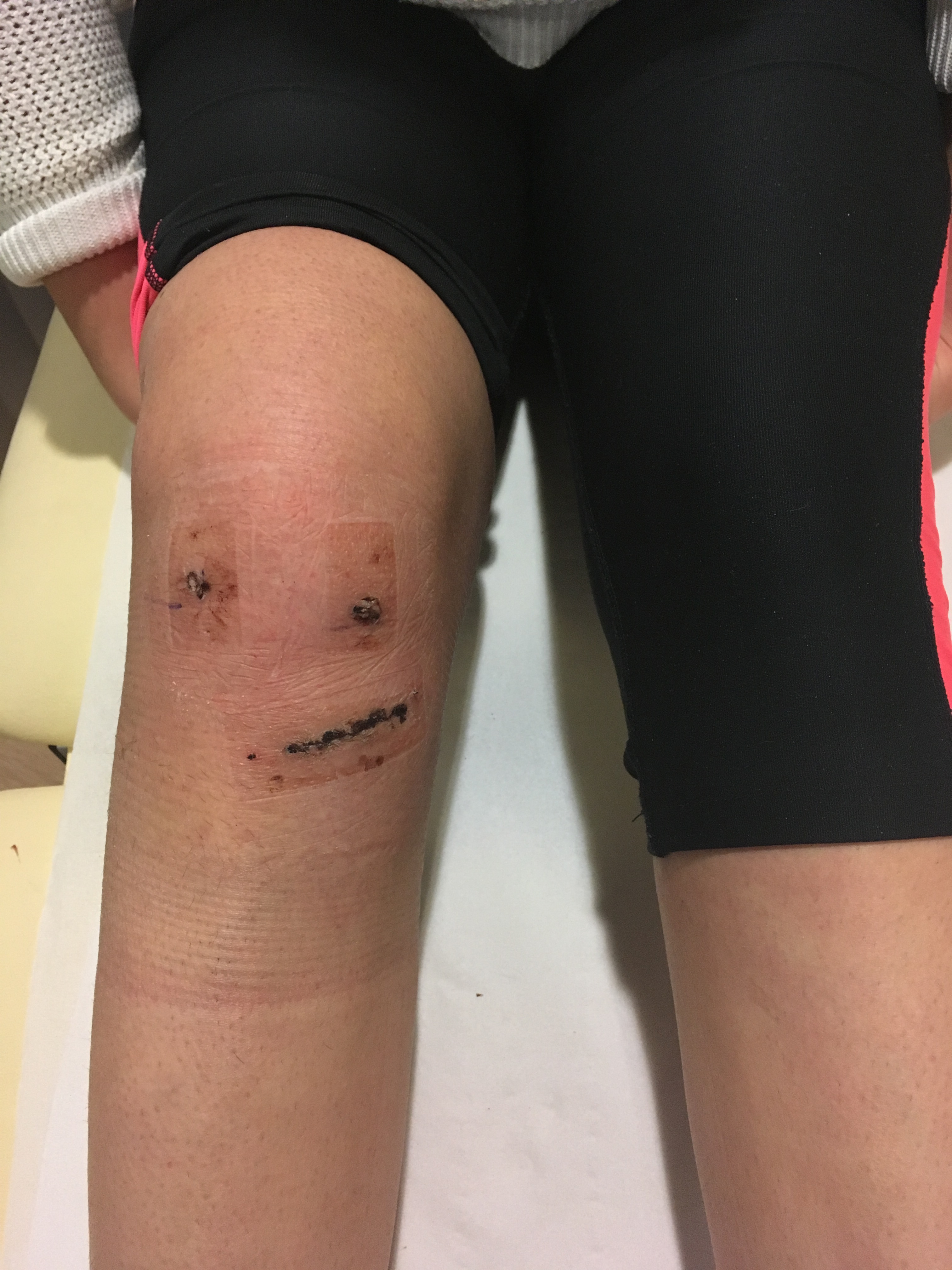 acl surgery scar acl surgery scar