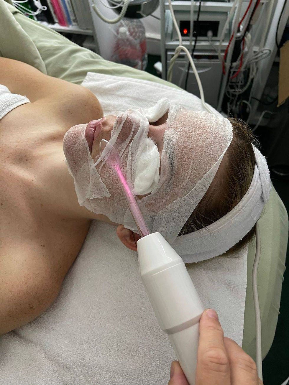 Acne Treatment High Frequency