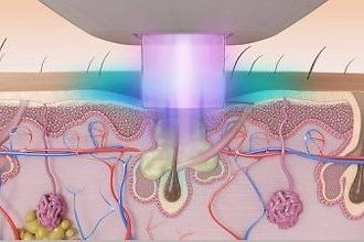 Acne Treatments in Salem, NH