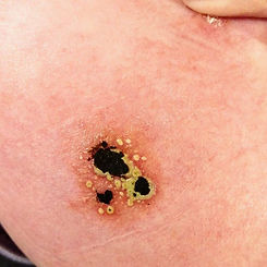 bloodroot black salve reaction cancer