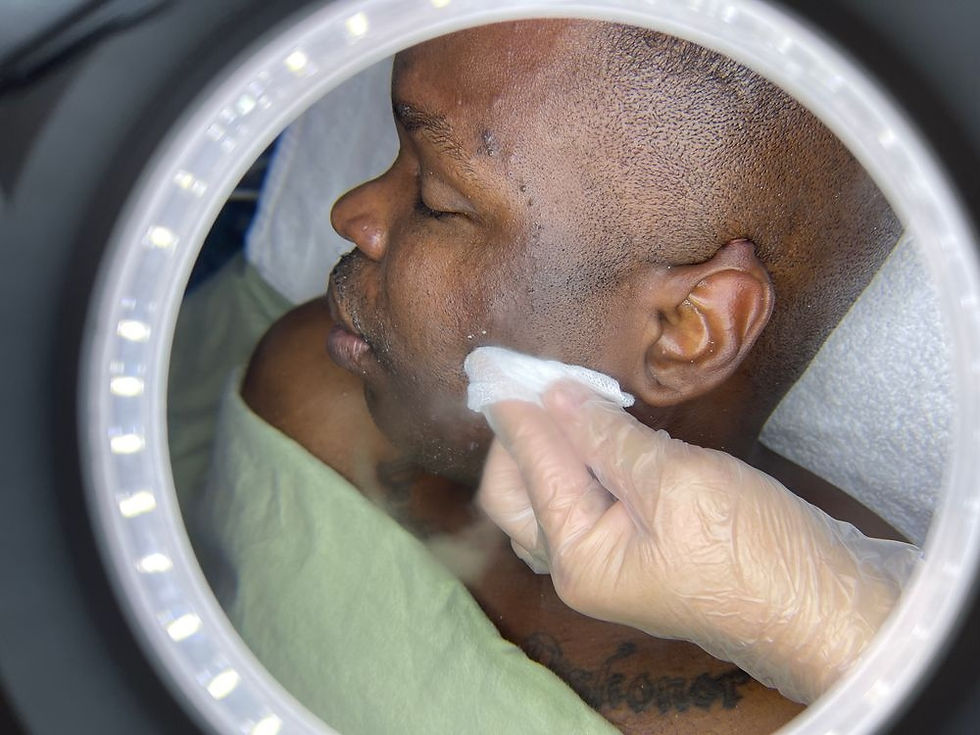 Acne Treatment -Extraction