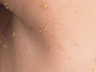 Skin Tag removal by registered nurse Camden & Narellan
