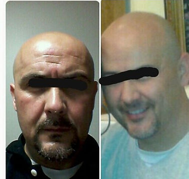 non-surgical facelift