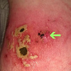 cancer black salve reaction