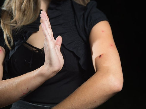 Bug bites