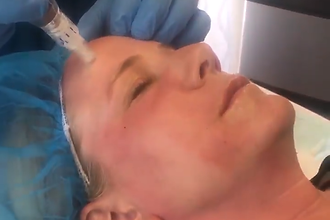 Vampire PRP Facials in Salem NH