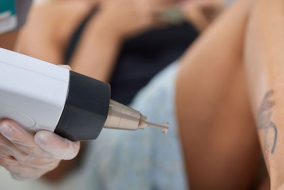 Laser behandeling om tattoo te verwijderen