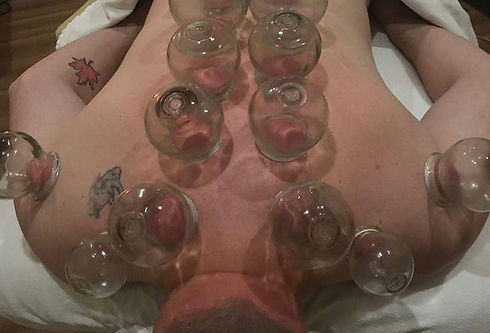 Fort Saskatchewan Cupping BodyTx, Fire cupping