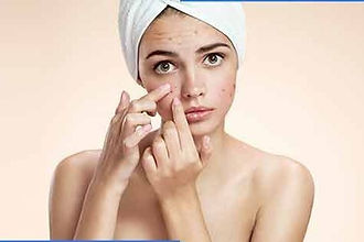 Acne treatment in Salem HN