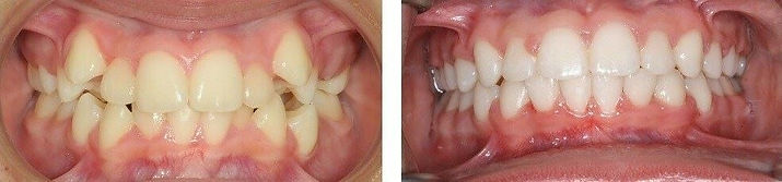 orthodontics for children