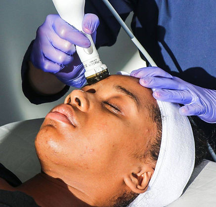 Acne, Acne Treatment, Adult Acne, Teen Acne, Plasma Facial, Plasma Clear, Hormonal Acne