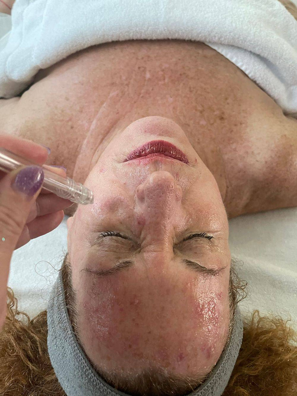 Jet Peel Injection Deep Cleaning Facial