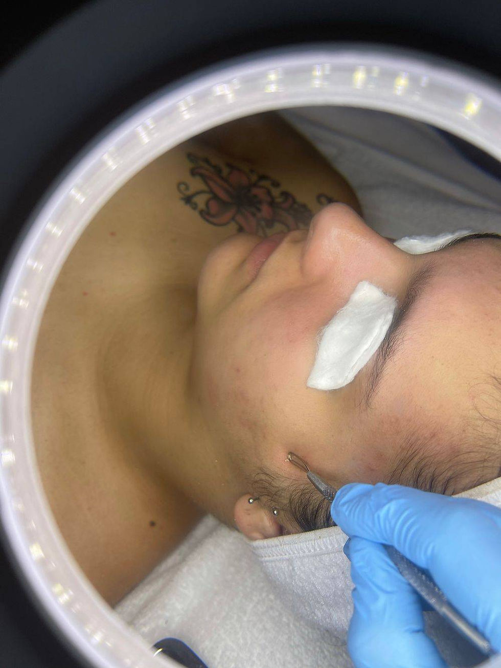 Extraction Teen Acne