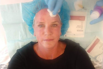 Vampire Facials in Salem NH