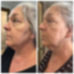 Avant apres soins radio frequence
