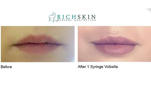 Before and after images of Dermal Fillers at Richskin Medical Aesthetics in Salem NH
